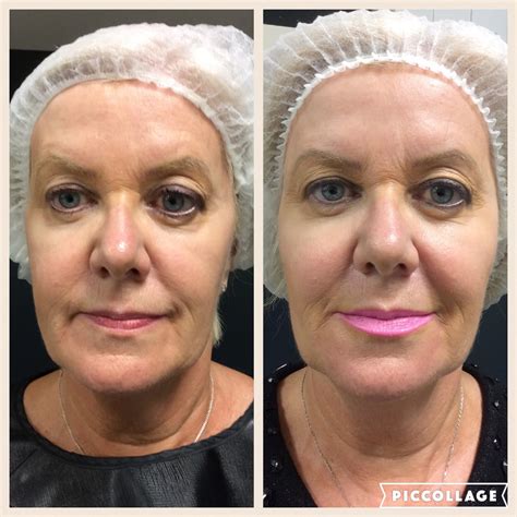 Dermal Fillers Photo Gallery Cosmetic Doctor Dublin Cosmetic Doctor