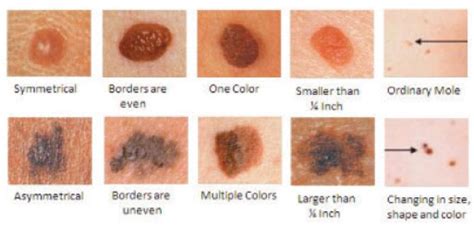 Skin Cancer 101 A Review Of The 3 Most Common Skin Cancers