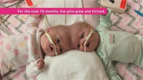 Formerly Conjoined Nc Twins Thriving Post Separation Surgery