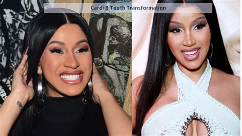 Cardi B Teeth Transformation Before And After Facts
