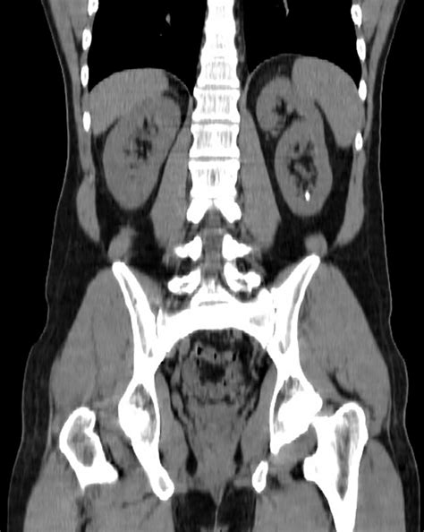 Ct Plain 8 × 6 Mm Left Renal Calculus In The Lower Pole Download