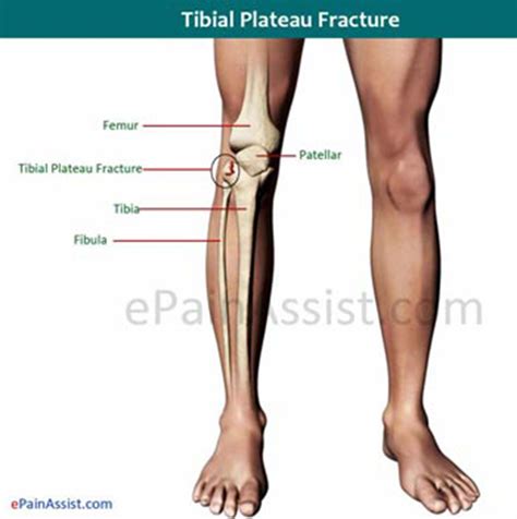 What Is Fractured Tibial Plateau Or Tibial Plateau Fracture