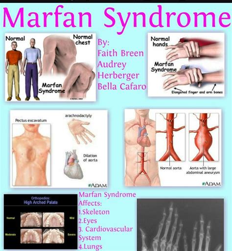 Affects A Person S Connective Tissue Marfan Syndrome Cardiovascular