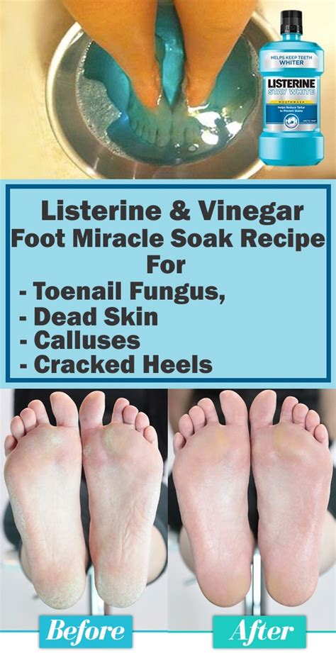 Listerine And Vinegar Foot Miracle Soak Recipe For Toenail Fungus Dead Skin Calluses And Cracked