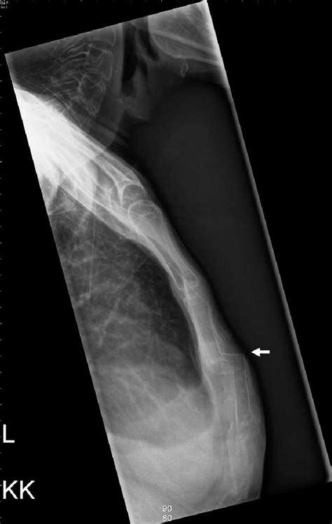 Broken Sternum X Ray