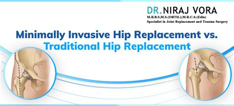 Minimally Invasive Hip Replacement Vs Traditional Hip Replacement Dr