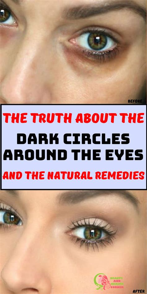 How To Naturally Remove Those Dark Circles Under Your Eyes At Home In