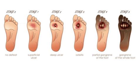 Diabetic Foot Ulcers Symptoms Causes And Risk Factors Pristyn Care My