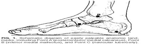 Percutaneous Pin Placement In The Medial Calcaneus Is Anywh