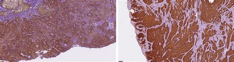Immunohistochemical Staining For P16 In Hpv Positive And Negative