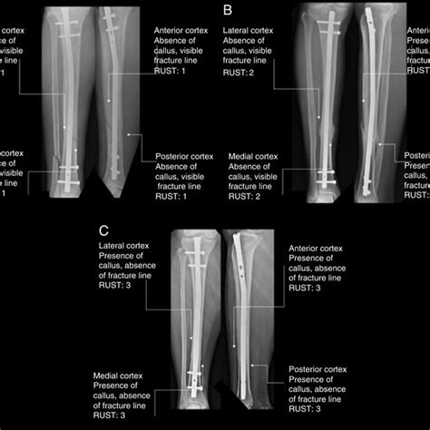 A A 52 Year Old Male Patient Segmental Tibial Fracture B