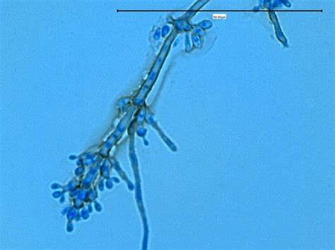 Conidial forms of fonsecaea pedrosoi, grown under conditions where melanin was or was not synthesized, were. Fun With Microbiology (What's Buggin' You?): Fonsecaea ...
