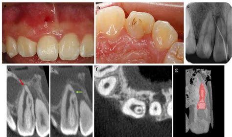 Non Surgical Removal Of Dens Invaginatus In Maxillary Lateral Incisor