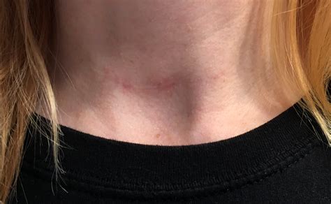 How Long Does It Take For The Thyroid Cancer Surgery Scar To Disappear