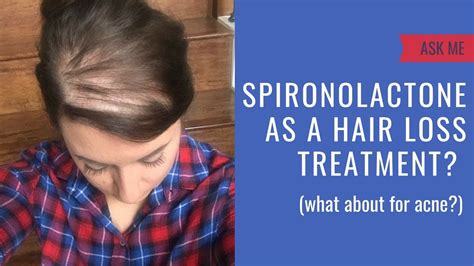Top 48 Image Does Spironolactone Cause Hair Loss Vn
