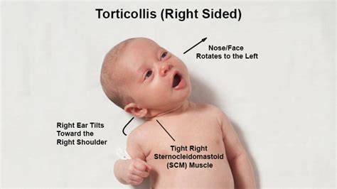 Congenital Torticollis Pediatric Practice Pearls For Your Pediatric Office Practice