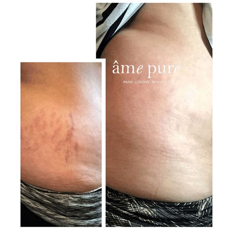 Intensive Stretch Marks Eraser âme Pure Amepure Eu