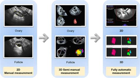 Advanced Ultrasound Techniques In Follicular Monitoring Download