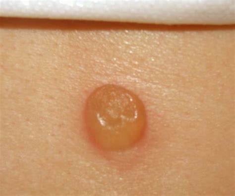 Hobo Spider Bite Pictures Symptoms Treatment Stages