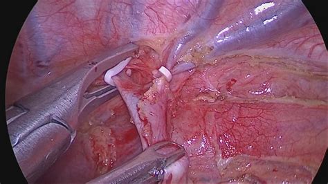 Mckeown esophagectomy is the preferred approach for locally advanced esophageal carcinomas in many centers. Esophagectomy - YouTube