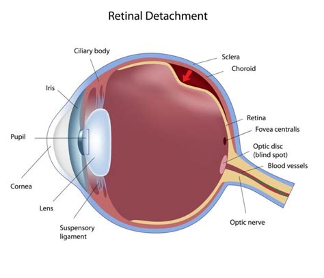 Retinal Detachment Causes Symptoms Diagnosis Treatment