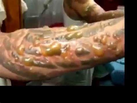 Looking for tips on how to care for your healing skin? Infected Tattoo - YouTube