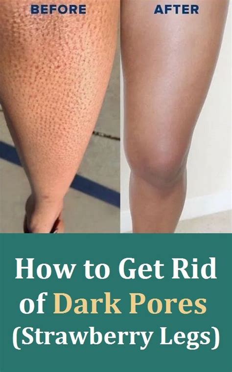 How To Get Rid Of Dark Pores Strawberry Legs Strawberry Legs Dark