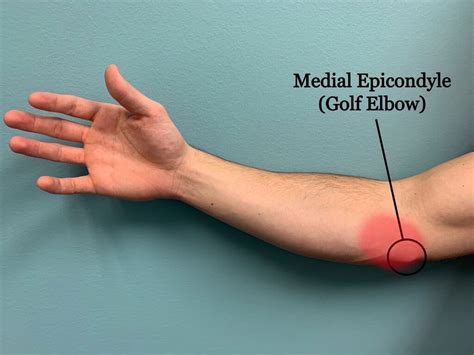 Golfers Elbow Medial Epicondylitis Motus Physical Therapy