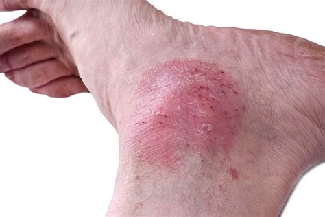 Skin Rashes On Feet