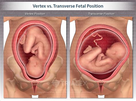 Vertex Vs Transverse Fetal Position TrialExhibits Inc