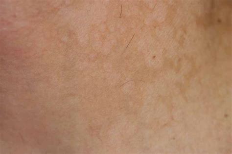 Get the facts on tinea versicolor (pityriasis versicolor) causes, signs, symptoms, and skin fungus treatment. Tinea Versicolor (pityriasis versicolor)