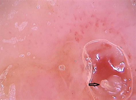 Dermoscopic Image Of Furuncular Myiasis Demonstrating The Presence Of Download Scientific