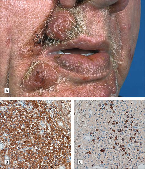 Primary Cutaneous Marginal Zone B Cell Lymphoma Clinical And