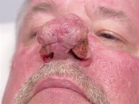Dr Pimple Popper Meets With Man Whose Skin Problem Nearly