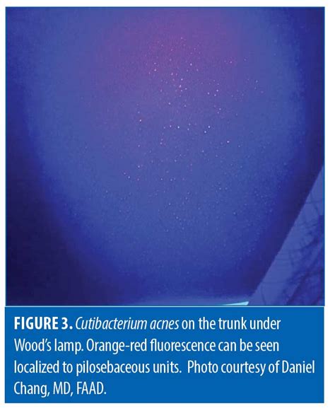 Revealing The Unseen A Review Of Woods Lamp In Dermatology Jcad