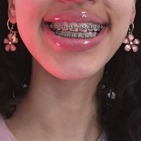 Lista 91 Foto Colores De Brackets Para Mujer Morena Cena Hermosa