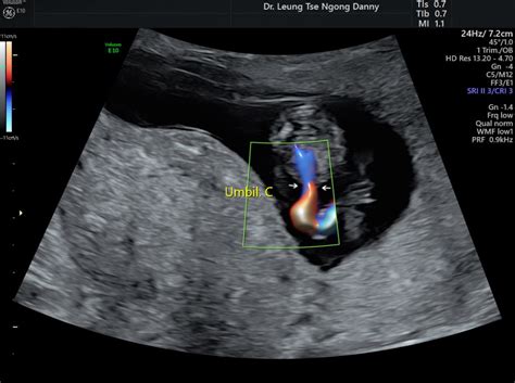 First Trimester Fetal Morphology Scan Hkog Info