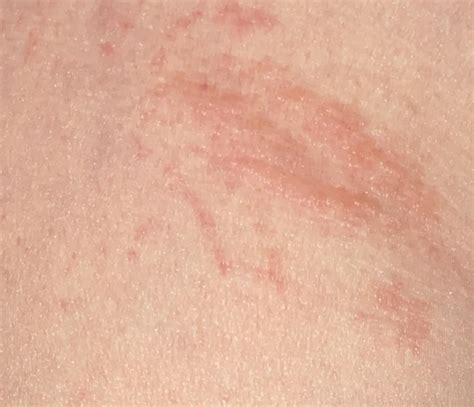 Rash On The Crease Where Buttocks Meets Legs Itchy And Stings Diagnoseme