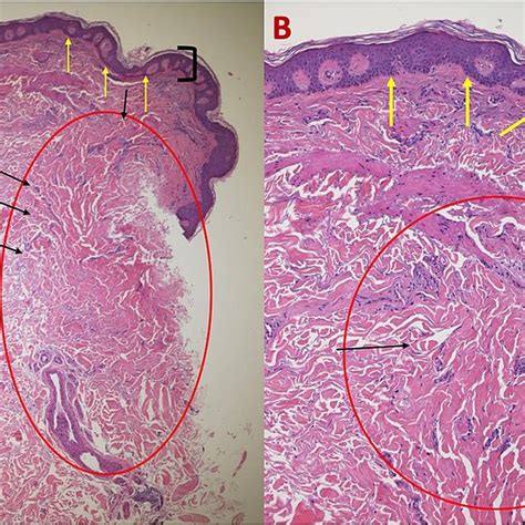 Histologic Features Of Atrophic Dermatofibroma On The Left Shoulder Of