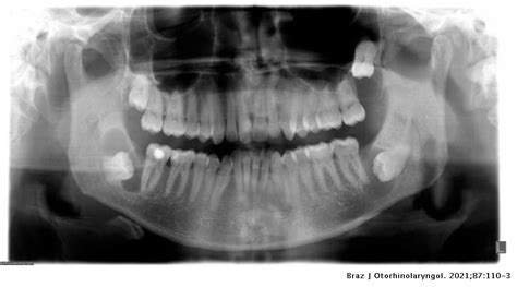 Unusual Multiple Dentigerous Cysts Evaluated By Cone Beam Computed