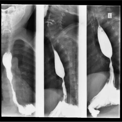 Barium Esophagogram Showing Proximal Two Third Esophageal Dilatation Download Scientific