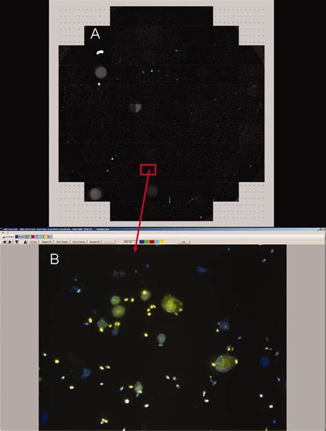 Digitized Microscopy In The Diagnosis Of Bladder Cancer Marganski Cancer