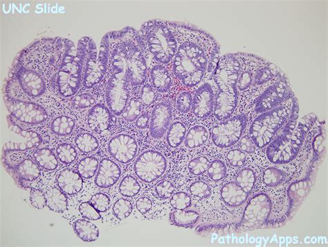 Ascending colon, transverse colon, descending colon, and sigmoid colon are the four components of the colon. adenomatous polyp large intestine, small intestine histology