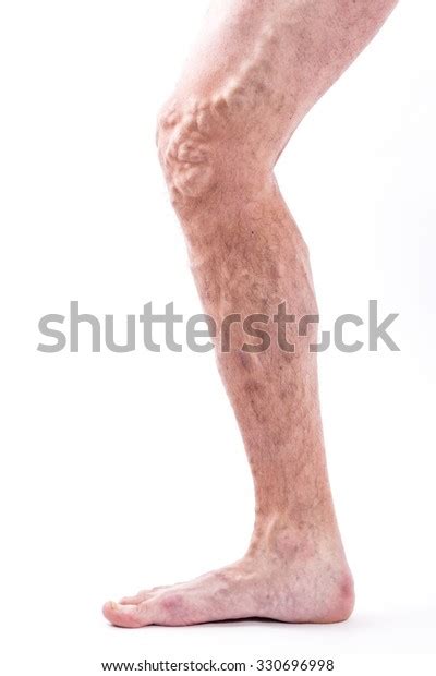 Human Leg Blocked Veins Thrombosis Phlebitis Stock Photo 330696998
