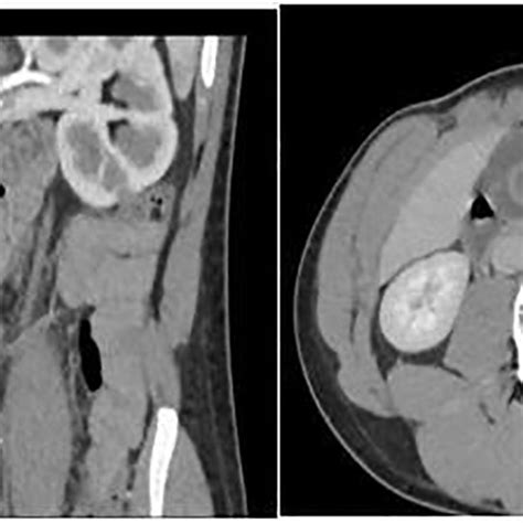 Abdominal Ct Revealed Gallbladder Wall Thickening With An Abrupt