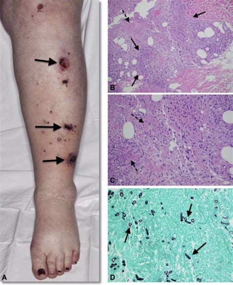 Diagnosis Of Deep Cutaneous Fungal Infections Correlation Between Skin