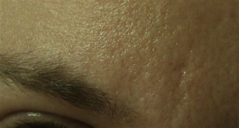 Scars On Forehead And Nose Orange Peel Scar Treatments