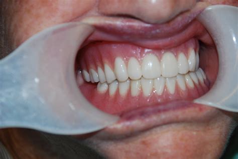 Implant Supported Overdenture 19th Avenue Dental
