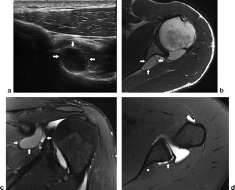 Paralabral Cyst In The Spinoglenoid Notch Of The Left Shoulder A
