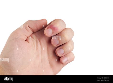Persona Con Infección De Los Dedos Dolor En Las Uñas Aislado Sobre